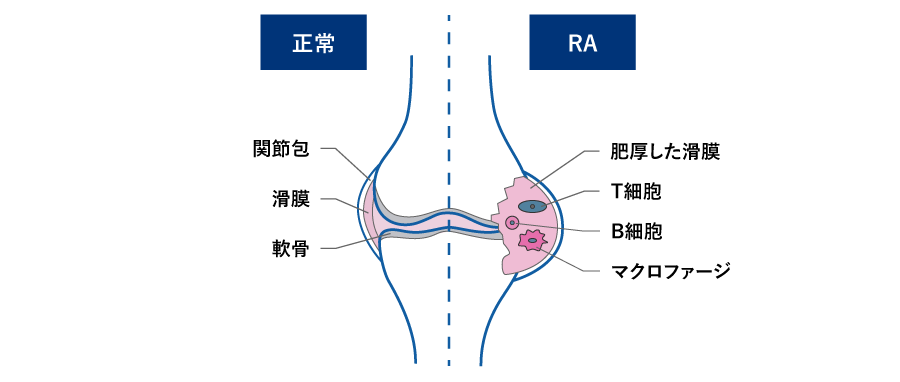 正常な関節と関節リウマチの関節